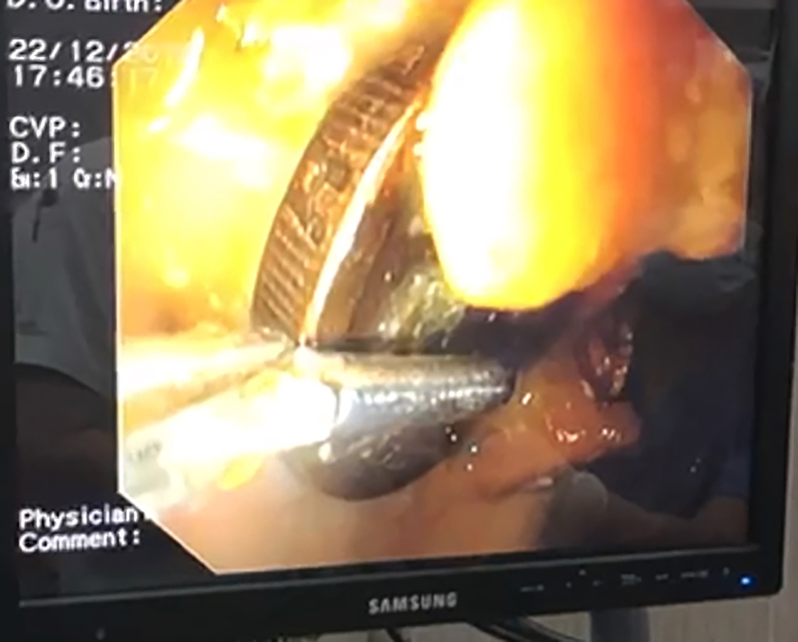 An endoscopic view displaying the extraction of a gastrointestinal foreign body from a dog.